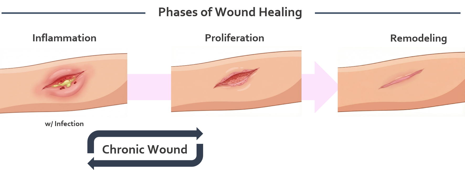 Phases of Wound Healing